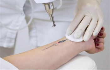 Tattoo Removal by laser treatment
